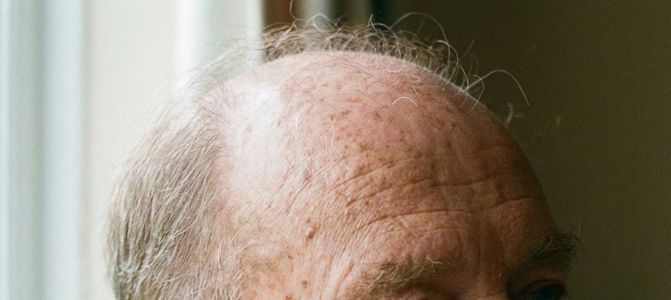 薄毛市場6,000億円時代へ　医療が主導する育毛・毛髪再生の最前線